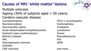 Causes of MRI ‘white matter’ lesionsCauses of MRI ‘white matter’ lesions
Multiple sclerosisMultiple sclerosis
Ageing (30% of subjects aged > 50 years)Ageing (30% of subjects aged > 50 years)
Cerebro-vascular diseaseCerebro-vascular disease
LeucodystrophiesLeucodystrophies HTLV-1 a/myelopathyHTLV-1 a/myelopathy
NeurosarcoidosisNeurosarcoidosis HydrocephalusHydrocephalus
Neuromyelitis opticaNeuromyelitis optica IrradiationIrradiation
Acute disseminated encephalomyelitisAcute disseminated encephalomyelitis LymphomaLymphoma
Systemic lupus erythematosusSystemic lupus erythematosus ToxinsToxins
Behcet’s diseaseBehcet’s disease PhenylketonuriaPhenylketonuria
PMLPML HIVHIV
Decompression sicknessDecompression sickness SSPESSPE
CADASILCADASIL
CNS vasculitisCNS vasculitis and more…and more…
 