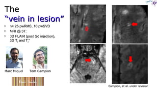 TheThe
“vein in lesion”“vein in lesion”
o n= 25 pwRMS, 10 pwSVDn= 25 pwRMS, 10 pwSVD
o MRI @ 3T:MRI @ 3T:
o 3D FLAIR (post Gd injection),3D FLAIR (post Gd injection),
3D T3D T22 and Tand T22**
Tom CampionTom CampionMarc MiquelMarc Miquel
Campion, et al.Campion, et al. under revisionunder revision
 
