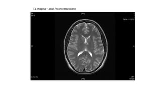 T2 imaging – axial / transverse plane
 