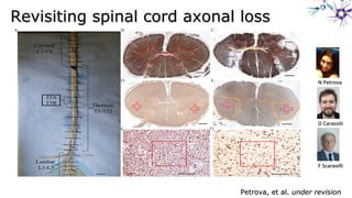 Revisiting spinal cord axonal lossRevisiting spinal cord axonal loss
D CarassitiD Carassiti
F ScaravilliF Scaravilli
N PetrovaN Petrova
Petrova, et al.Petrova, et al. under revisionunder revision
 