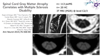 JNNP 2014JNNP 2014
Ann Neurol 2014;76:568-80Ann Neurol 2014;76:568-80
n= 113 pwMSn= 113 pwMS
n= 20 HCn= 20 HC
3T MRI (PSIR) @ level C2/33T MRI (PSIR) @ level C2/3
 