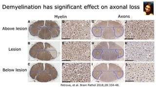 MyelinMyelin AxonsAxons
Above lesionAbove lesion
Below lesionBelow lesion
LesionLesion
Petrova, et al. Brain Pathol 2018;28:334-48.Petrova, et al. Brain Pathol 2018;28:334-48.
Demyelination has significant effect on axonal lossDemyelination has significant effect on axonal loss
 