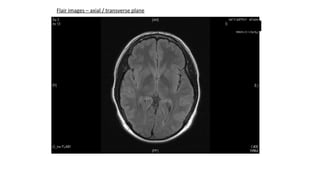 Flair images – axial / transverse plane
 