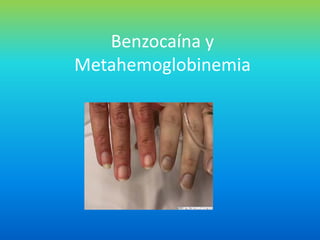 Benzocaína y
Metahemoglobinemia
 