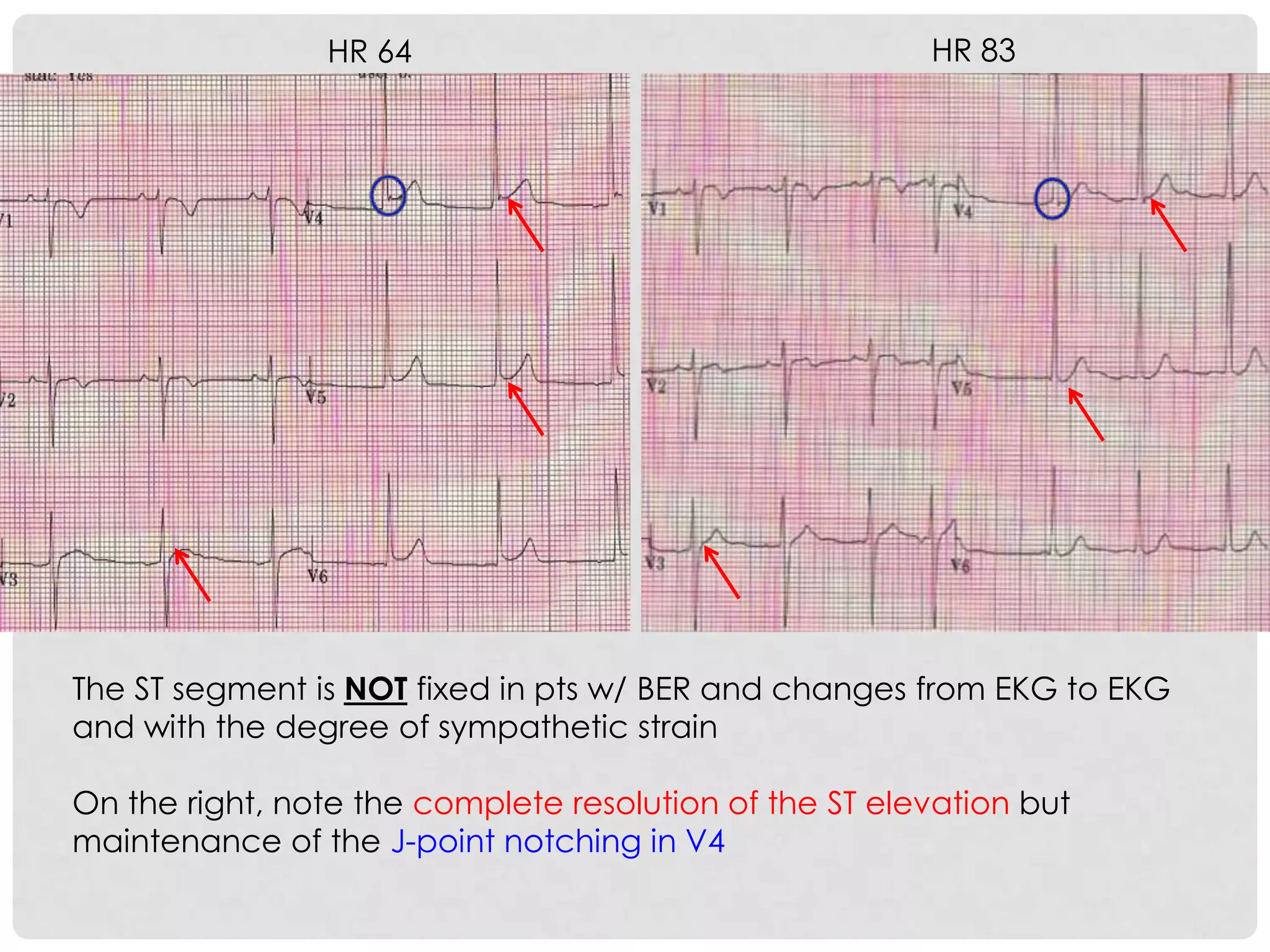 HR 64                                   HR 83




The ST segment is NOT fixed in pts w/ BER and changes from EKG to EKG
and with the degree of sympathetic strain

On the right, note the complete resolution of the ST elevation but
maintenance of the J-point notching in V4
 