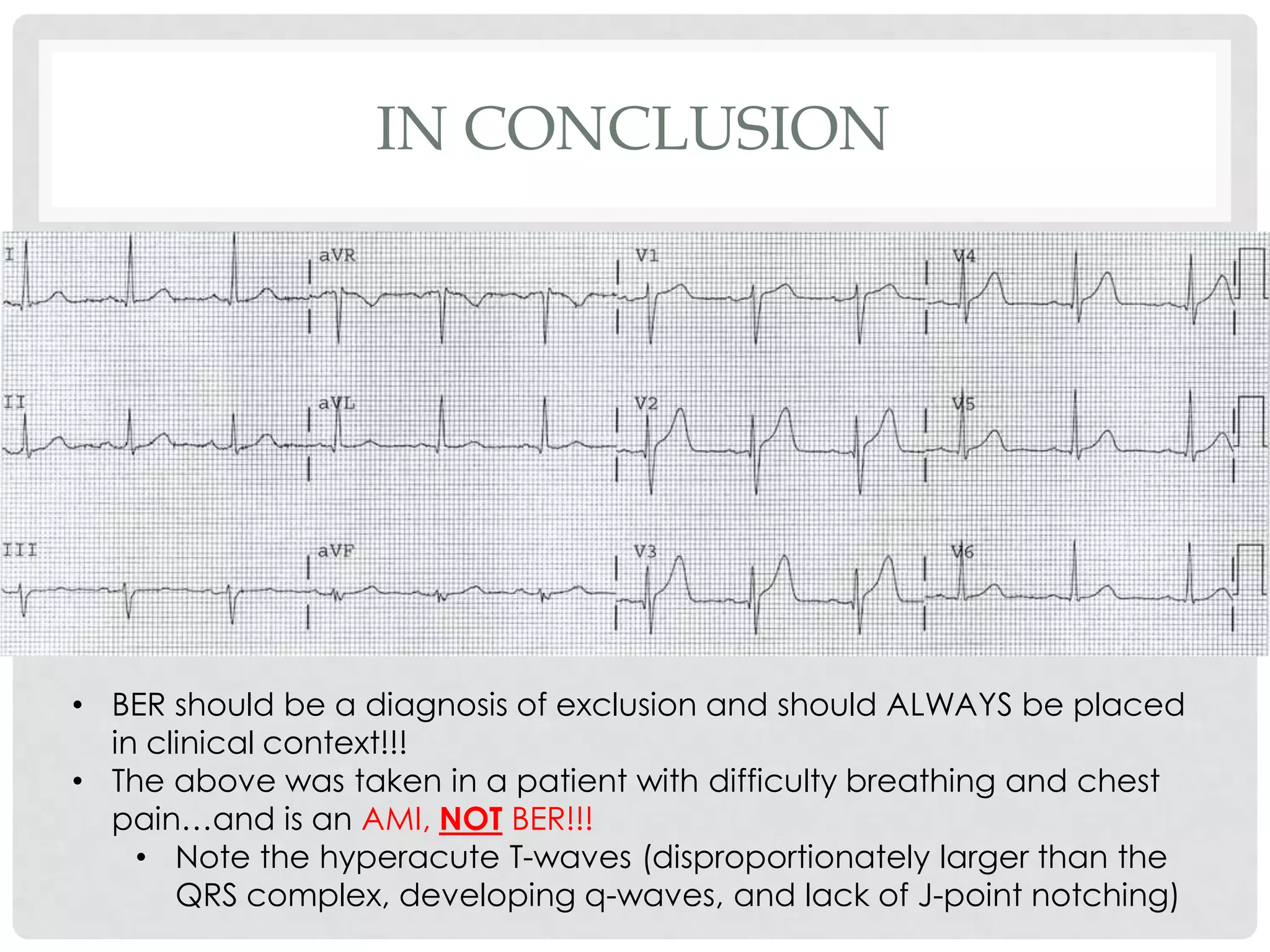 IN CONCLUSION




• BER should be a diagnosis of exclusion and should ALWAYS be placed
  in clinical context!!!
• The above was taken in a patient with difficulty breathing and chest
  pain…and is an AMI, NOT BER!!!
    • Note the hyperacute T-waves (disproportionately larger than the
       QRS complex, developing q-waves, and lack of J-point notching)
 