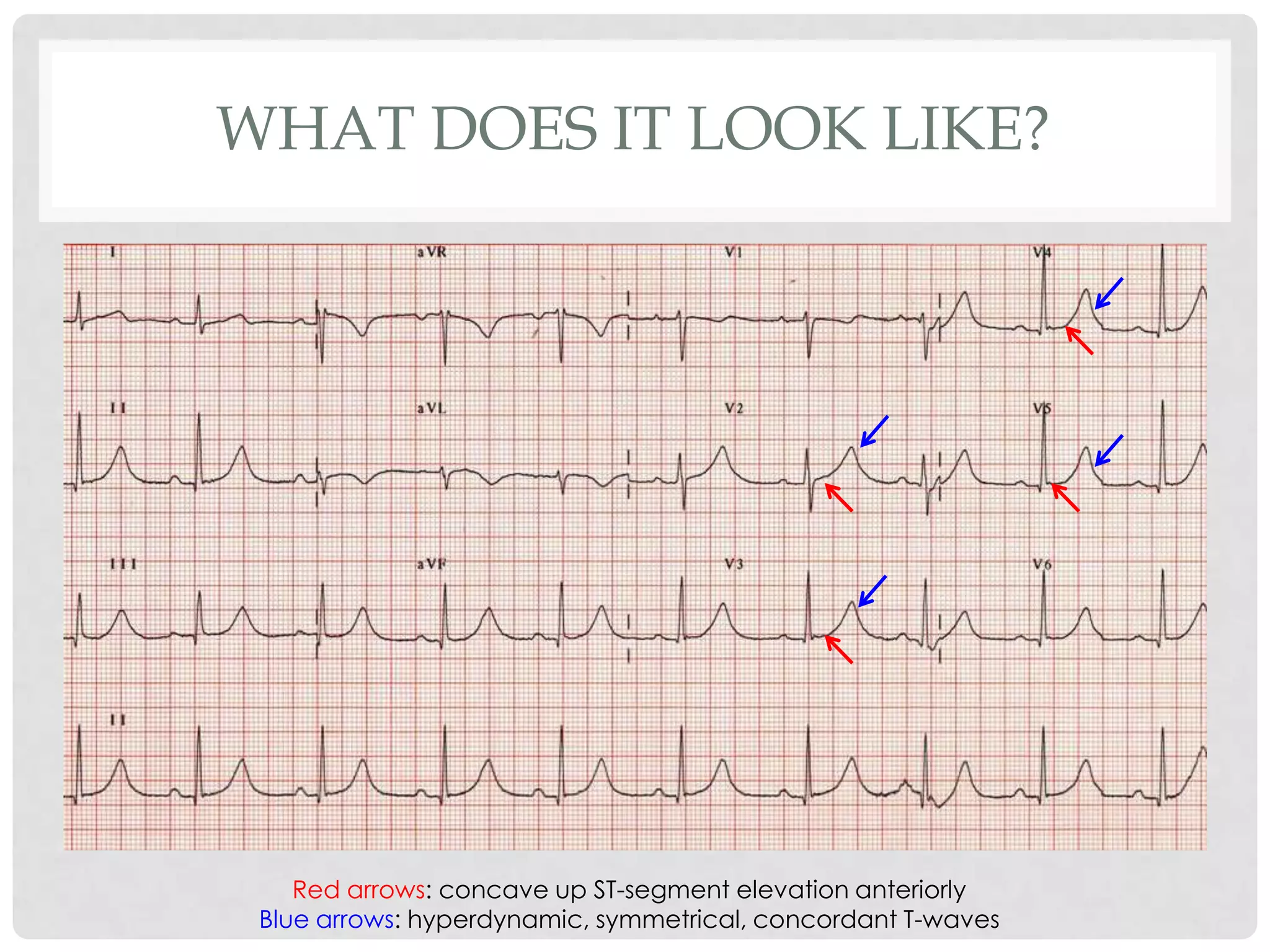 WHAT DOES IT LOOK LIKE?




    Red arrows: concave up ST-segment elevation anteriorly
 Blue arrows: hyperdynamic, symmetrical, concordant T-waves
 