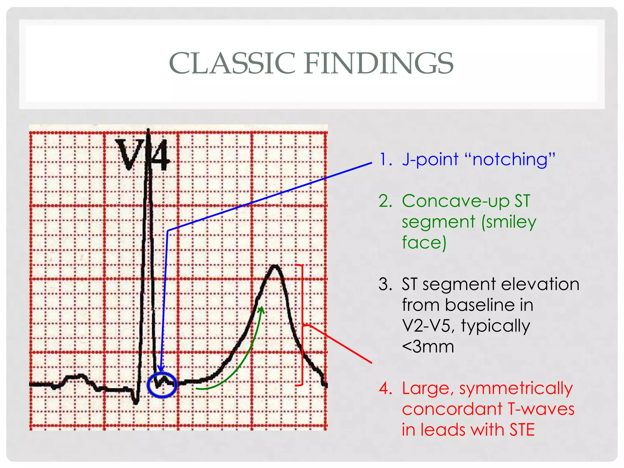 CLASSIC FINDINGS


           1. J-point “notching”

           2. Concave-up ST
              segment (smiley
              face)

           3. ST segment elevation
              from baseline in
              V2-V5, typically
              <3mm

           4. Large, symmetrically
              concordant T-waves
              in leads with STE
 