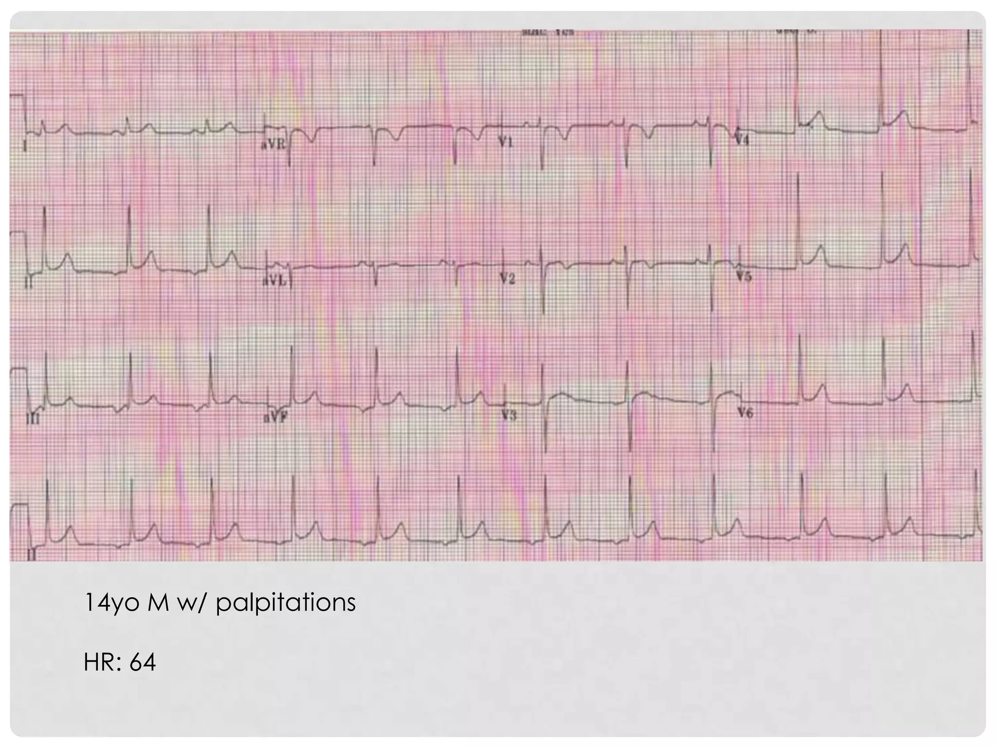 14yo M w/ palpitations

HR: 64
 