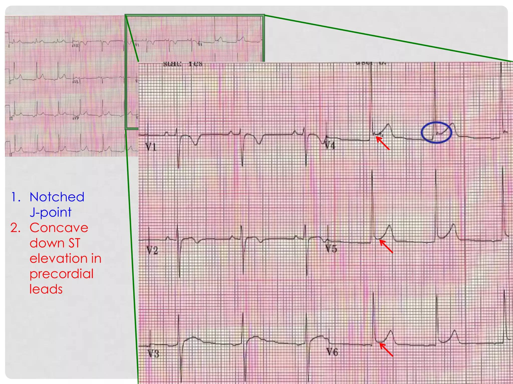 1. Notched
   J-point
2. Concave
   down ST
   elevation in
   precordial
   leads
 