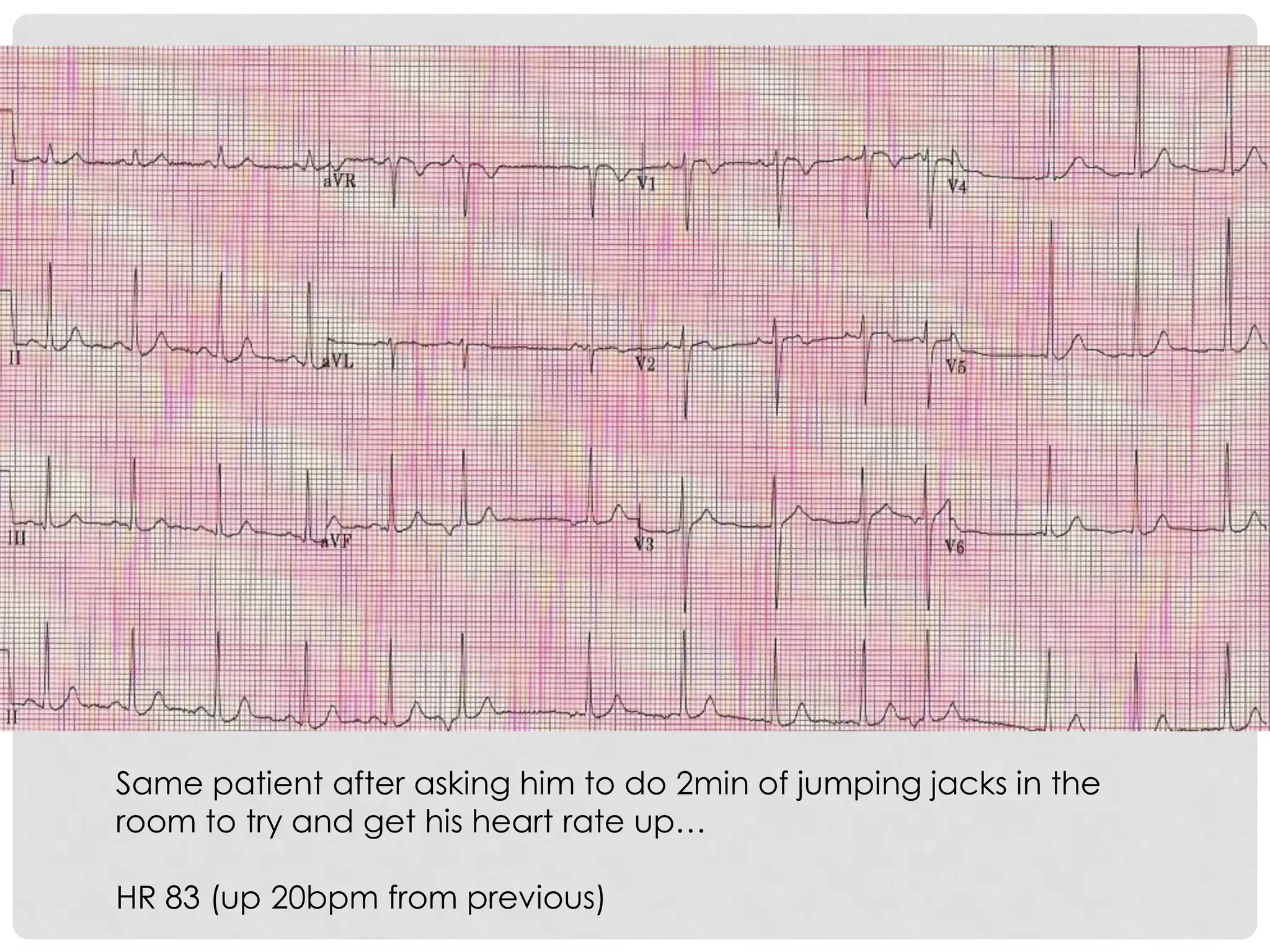 Same patient after asking him to do 2min of jumping jacks in the
room to try and get his heart rate up…

HR 83 (up 20bpm from previous)
 