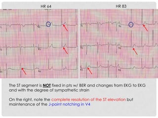 HR 64                                   HR 83




The ST segment is NOT fixed in pts w/ BER and changes from EKG to EKG
and with the degree of sympathetic strain

On the right, note the complete resolution of the ST elevation but
maintenance of the J-point notching in V4
 