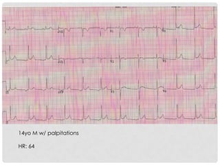 14yo M w/ palpitations

HR: 64
 