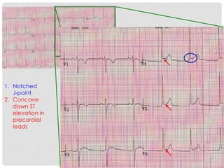 1. Notched
   J-point
2. Concave
   down ST
   elevation in
   precordial
   leads
 
