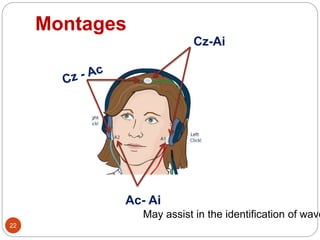Montages
22
Cz-Ai
Ac- Ai
May assist in the identification of wave
 