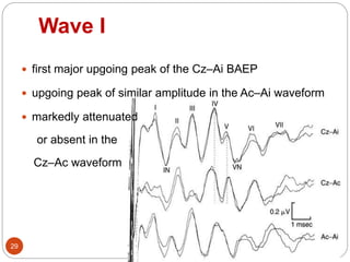 Wave I
29
 first major upgoing peak of the Cz–Ai BAEP
 upgoing peak of similar amplitude in the Ac–Ai waveform
 markedly attenuated
or absent in the
Cz–Ac waveform
 