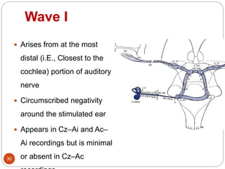 Wave I
30
 Arises from at the most
distal (i.E., Closest to the
cochlea) portion of auditory
nerve
 Circumscribed negativity
around the stimulated ear
 Appears in Cz–Ai and Ac–
Ai recordings but is minimal
or absent in Cz–Ac
 