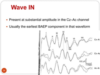 Wave IN
34
 Present at substantial amplitude in the Cz–Ac channel
 Usually the earliest BAEP component in that waveform
 