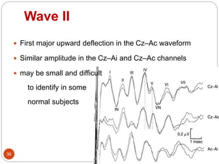 Wave II
36
 First major upward deflection in the Cz–Ac waveform
 Similar amplitude in the Cz–Ai and Cz–Ac channels
 may be small and difficult
to identify in some
normal subjects
 