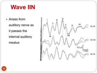 Wave IIN
38
 Arises from
auditory nerve as
it passes the
internal auditory
meatus
 