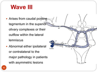 Wave III
40
 Arises from caudal pontine
tegmentum in the superior
olivary complexes or their
outflow within the lateral
lemniscus
 Abnormal either ipsilateral
or contralateral to the
major pathology in patients
with asymmetric lesions
 