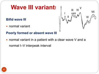 Wave III variants
41
Bifid wave III
 normal variant
Poorly formed or absent wave III
 normal variant in a patient with a clear wave V and a
normal I–V interpeak interval
 