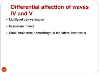 Differential affection of waves
IV and V
51
 Multilevel demyelination
 Brainstem infarct
 Small brainstem hemorrhage in the lateral lemniscus
 