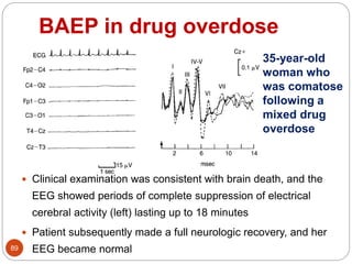 BAEP in drug overdose
89
 Clinical examination was consistent with brain death, and the
EEG showed periods of complete suppression of electrical
cerebral activity (left) lasting up to 18 minutes
 Patient subsequently made a full neurologic recovery, and her
EEG became normal
35-year-old
woman who
was comatose
following a
mixed drug
overdose
 