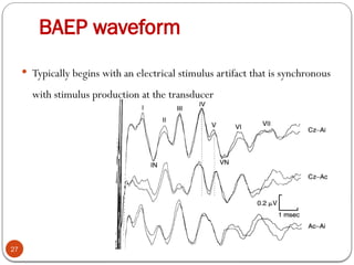 BAEP waveform
27
 Typically begins with an electrical stimulus artifact that is synchronous
with stimulus production at the transducer
 