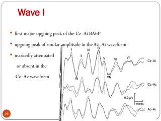 Wave I
29
 first major upgoing peak of the Cz–Ai BAEP
 upgoing peak of similar amplitude in the Ac–Ai waveform
 markedly attenuated
or absent in the
Cz–Ac waveform
 