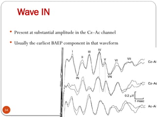 Wave IN
34
 Present at substantial amplitude in the Cz–Ac channel
 Usually the earliest BAEP component in that waveform
 