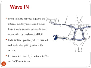 Wave IN
35
 From auditory nerve as it passes the
internal auditory meatus and moves
from a nerve encased in bone to one
surrounded by cerebrospinal fluid
 Field includes positivity at the mastoid
and far-field negativity around the
vertex
 In contrast to wave I, prominent in Cz–
Ac BAEP waveforms
 