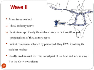 Wave II
37
 Arises from two loci
a) distal auditory nerve
b) brainstem, specifically the cochlear nucleus or its outflow and
proximal end of the auditory nerve
 Earliest component affected by pontomedullary CVAs involving the
cochlear nucleus
 Usually predominant over the dorsal part of the head and a clear wave
II in the Cz–Ac waveform
 