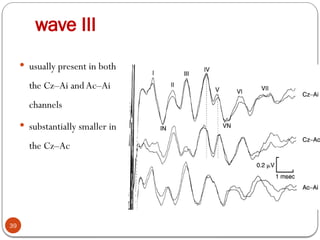 wave III
39
 usually present in both
the Cz–Ai and Ac–Ai
channels
 substantially smaller in
the Cz–Ac
 