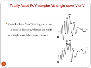 Totally fused IV/V complex Vs single wave IV or V
46
 Complex has a “base” that is greater than
1.5 msec in duration, whereas the width
of a single wave is less than 1.5 msec
 