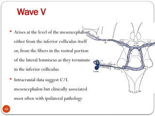 Wave V
48
 Arises at the level of the mesencephalon,
either from the inferior colliculus itself
or, from the fibers in the rostral portion
of the lateral lemniscus as they terminate
in the inferior colliculus
 Intracranial data suggest C/L
mesencephalon but clinically associated
most often with ipsilateral pathology
 