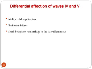 Differential affection of waves IV and V
51
 Multilevel demyelination
 Brainstem infarct
 Small brainstem hemorrhage in the lateral lemniscus
 