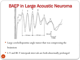 BAEP in Large Acoustic Neuroma
81
 Large cerebellopontine angle tumor that was compressing the
brainstem
 I–V and III–V interpeak intervals are both abnormally prolonged
 