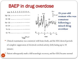 BAEP in drug overdose
89
 Clinical examination was consistent with brain death, and the EEG showed periods
of complete suppression of electrical cerebral activity (left) lasting up to 18
minutes
 Patient subsequently made a full neurologic recovery, and her EEG became normal
35-year-old
woman who was
comatose
following a
mixed drug
overdose
 