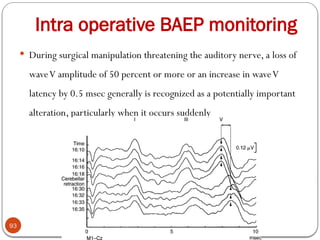 Intra operative BAEP monitoring
93
 During surgical manipulation threatening the auditory nerve, a loss of
waveV amplitude of 50 percent or more or an increase in waveV
latency by 0.5 msec generally is recognized as a potentially important
alteration, particularly when it occurs suddenly
 