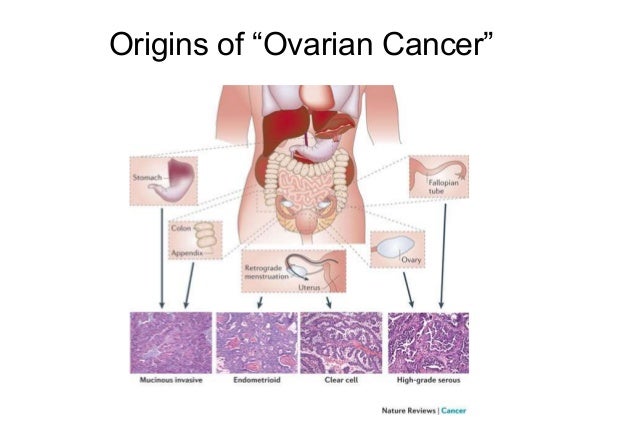 Ovarian Cancer Research and Prevention, Andrew Berchuck, MD