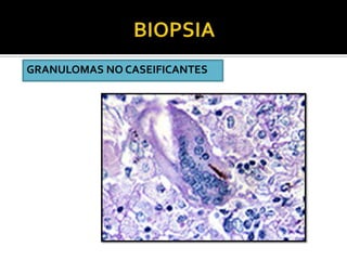 BIOPSIAGRANULOMAS NO CASEIFICANTES