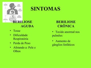 SINTOMAS BERILIOSE  AGUDA   Tosse Dificuldade Respiratória Perda de Peso  Afetando a: Pele e Olhos BERILIOSE CRÔNICA Tecido anormal nos pulmões Aumento de gânglios linfáticos 