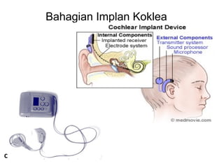 Bahagian Implan Koklea

CI devices, body-worn style (old one!)

 
