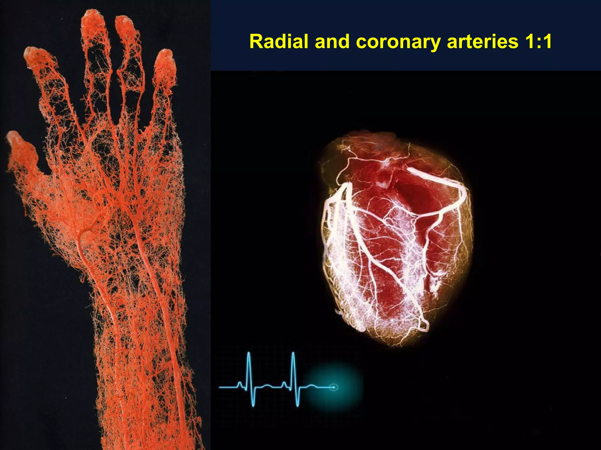 Bernat I - AIMRADIAL 2014 Technical - Radial artery occlusion | PPT