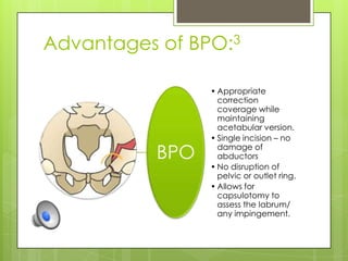 Bernese periacetabular osteotomy original | PPTX