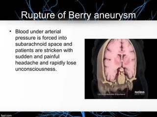 Rupture of Berry aneurysm
• Blood under arterial
pressure is forced into
subarachnoid space and
patients are stricken with
sudden and painful
headache and rapidly lose
unconsciousness.
 