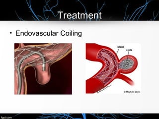 Treatment
• Endovascular Coiling
 