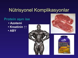 N ü tri syonel   K ompli k a syonlar Protein  aşırı ise •  Azotemi •  K reatinin  ↑↑   •  ABY 