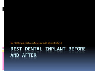 Dental Implants from Molesworth Clinic Ireland

BEST DENTAL IMPLANT BEFORE
AND AFTER
 